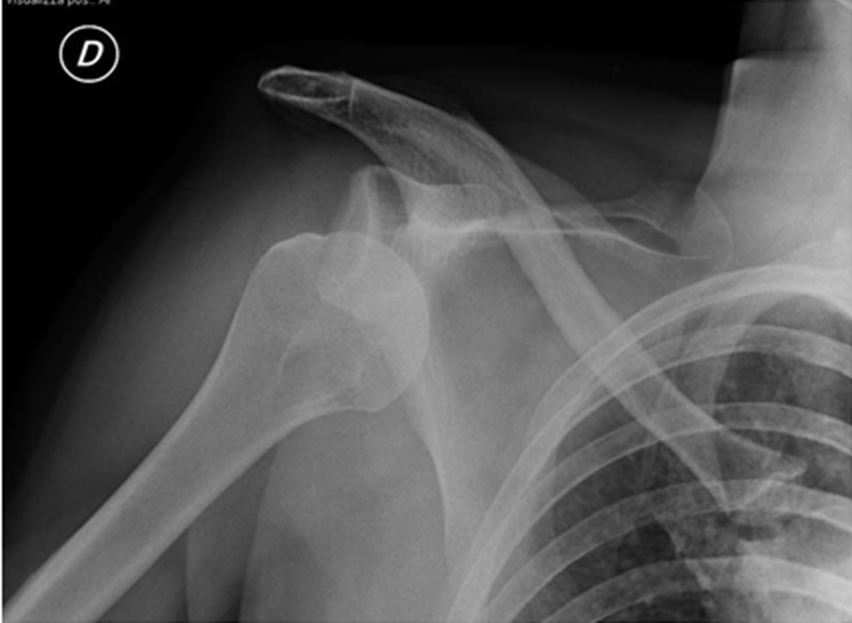 Radiographic analysis of antero-inferior glenohumeral luxation