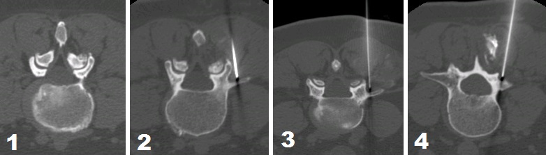 Immagini TC di vertebre con trattamento con radiofrequenza