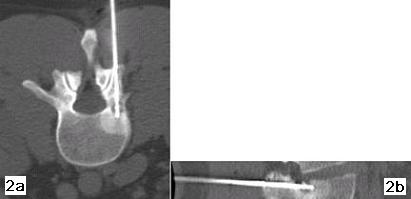 Figure 2a e 2b - La scansione TC sul piano trasversale (fig. 2a) e la ricostruzione su quello sagittale (fig. 2b) dimostrano il corretto posizionamento dell'agoelettrodo (22G). Dopo 10 ore dalla termoablazione il paziente non ha più accusato il tipico dolore da osteoma osteoide.