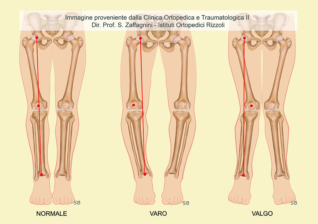 Immagine ginocchio normale, varo e valgo