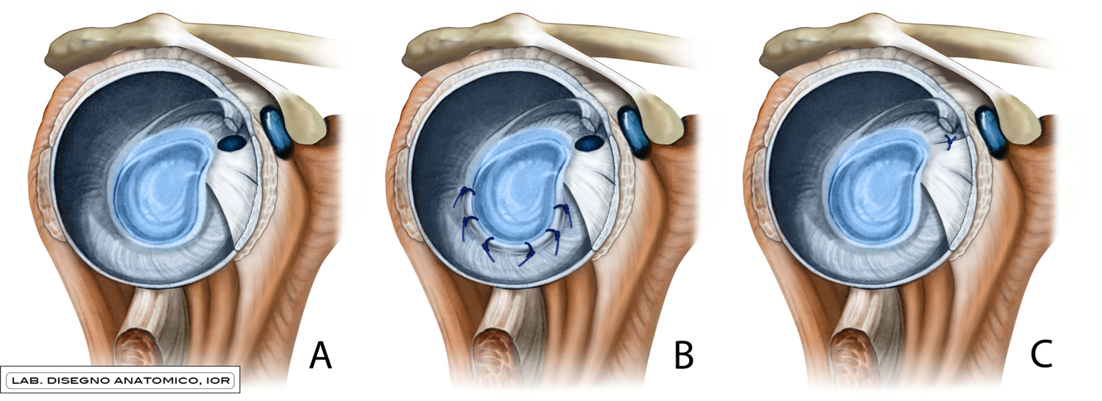 Schema che mostra la spalla in caso di anatomia normale (A), dopo un intervento di capsuloplastica artroscopica con plicature capsulo-labrali da ore 3 a ore 9 (B), e dopo chiusura verticale dell’intervallo dei rotatori sempre in artroscopia (C).