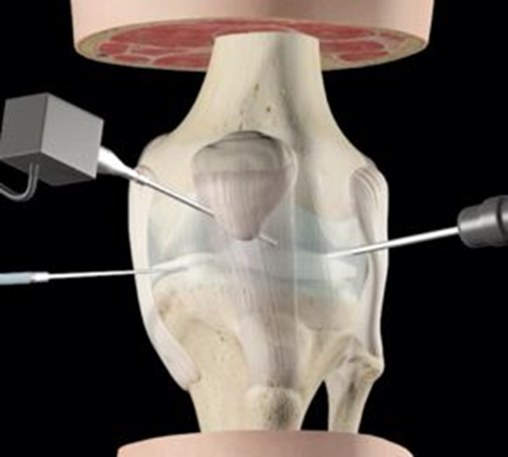 grafica di Tecnica mini-invasiva di esecuzione Artroscopica in chirurgia del ginocchio