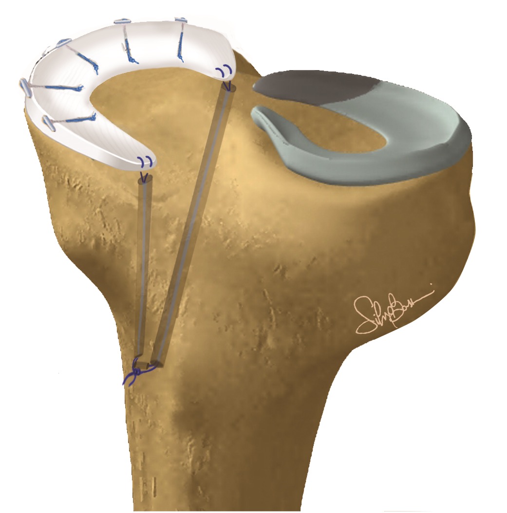 Trapianto di menisco interno eseguito con tecnica artroscopica
