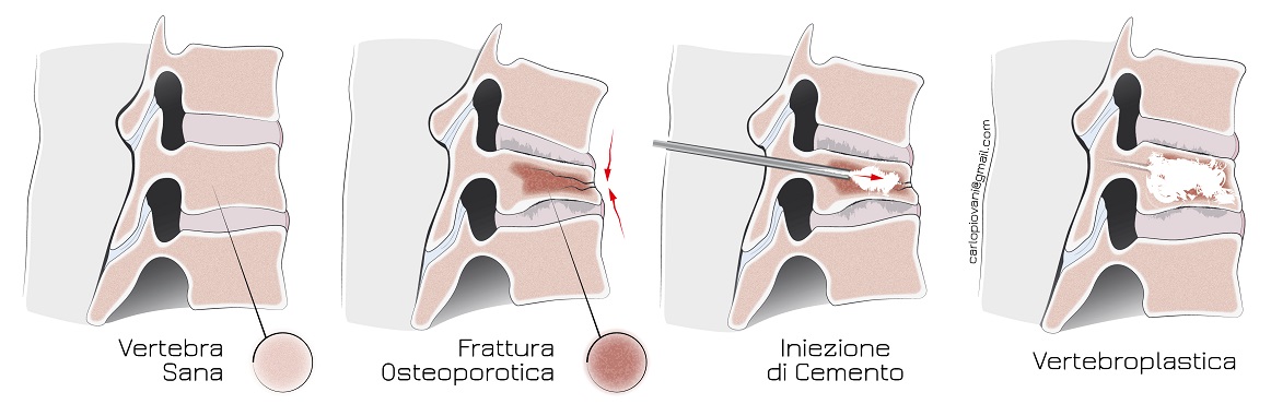 From left to right: healthy vertebra; osteoporotic fracture; cement injection; vertebroplasty