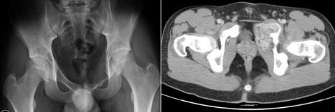 Lesione focale osteolitica della branca ileo-pubica sinistra riferibile a formazione cistica aneurismatica. A sinistra (fig. 1) radiografia; a destra (fig. 2) immagine TC.