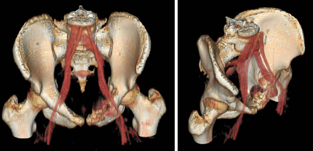 Figg. 14-15 - Immagini TC (ricostruzione 3D) prima dell’embolizzazione dove è apprezzabile la lesione focale osteolitica della branca ileo-pubica sinistra