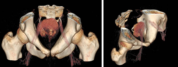 Figg. 16-17 - Immagini TC (ricostruzione 3D) dopo l’embolizzazione dove è apprezzabile la totale ristrutturazione ossea e guarigione della lesione.