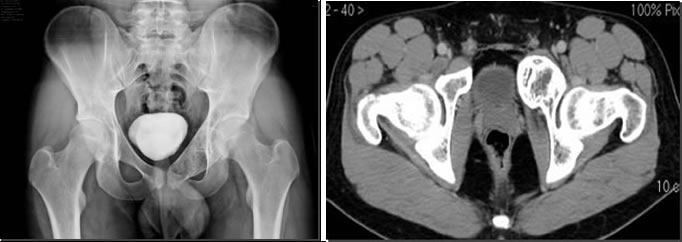 Figg. 12-13 - Immagini radiografiche e TC dopo l’embolizzazione dove è apprezzabile la totale ristrutturazione ossea e guarigione della lesione.