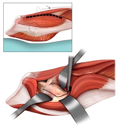 Fig.3 - Accesso anteriore all’anca destra. I capi muscolari non vengono disinseriti per esporre il piano capsulare