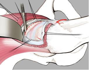 Fig. 2a - Dopo sezione della capsula articolare si espone il tessuto osseo dal versante acetabolare in esubero, causa di conflitto con il collo del femore