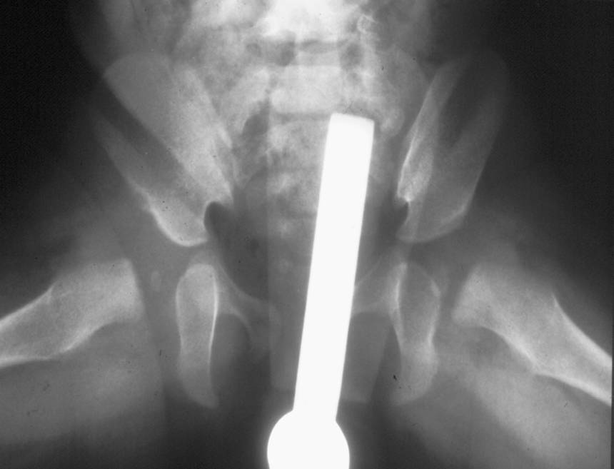 Fig.2 - Corretta centrazione epifisaria ad anca abdotta