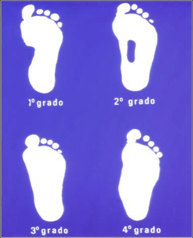 Fig.1: classificazione del piede piatto all'esame podoscopico in 4 gradi in base all'entità della deformità