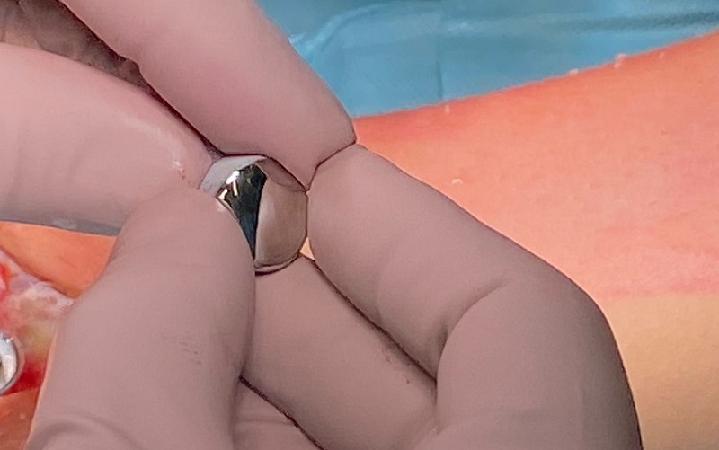 The personalised device with cobalt-chrome, titanium, hydroxyapatite alloy parts, which was implanted to replace the damaged cartilage and subchondral bone.