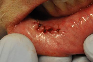 Biopsia delle ghiandole salivari minori