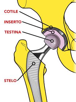 Protesi d'anca: illustrazione delle diverse componenti