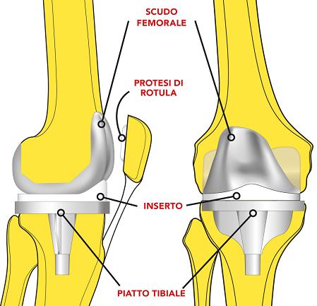 Knee prosthesis: illustration of the different components (femoral shield, kneecap prosthesis, insert, tibial plate)