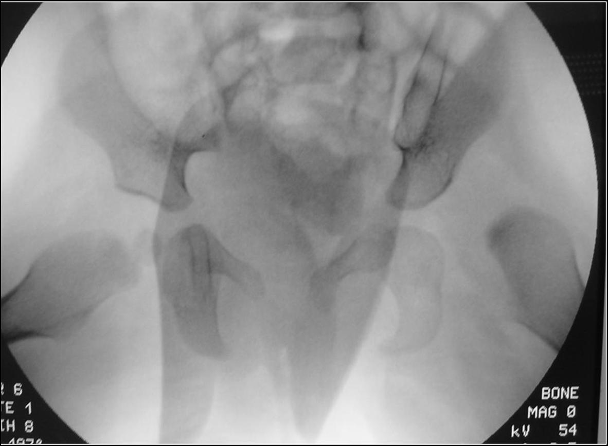 Fig.6a - Lussazione congenita dell'anca non riducibile