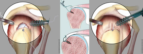 Fig. 1: Scheme of a suture in rotators cuff arthroscopy (Anatomical Drawing School, Rizzoli Orthopaedic Institute)