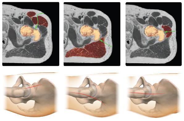 Fig.2 - Vie d’accesso per l’intervento di artroprotesi d’anca (da sinistra a destra accesso mini-invasivo anteriore, accesso mini-invasivo postero-laterale, accesso laterale diretto)