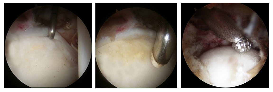 Fig. 10: Visione artroscopica di alcune procedure effettuate durante l'intervento
