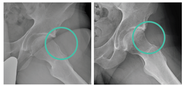 Fig. 4: Deformità ossea di tipo CAM e valutazione radiografica dopo la sua correzione