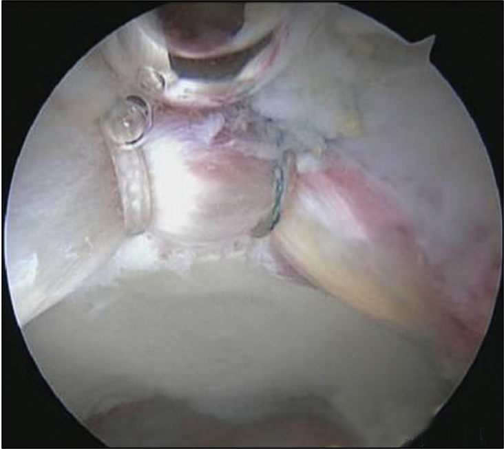 Fig 5: Visione artroscopica del labrum acetabolare dopo sutura