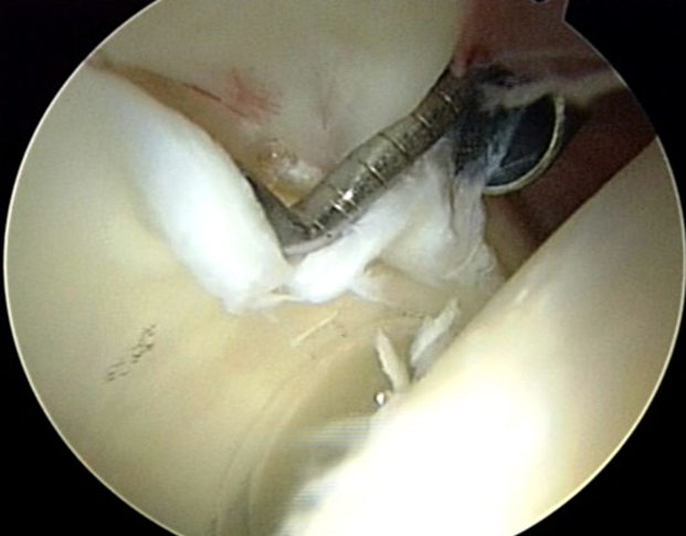 Fig. 6: Visione artroscopica di una lesione cartilaginea