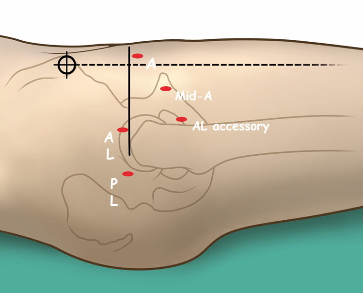 Fig. 9: Portali chirurgici usati in artroscopia d'anca