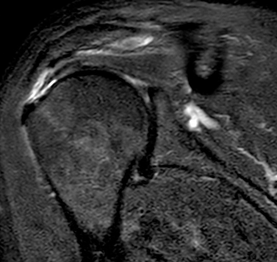 Fig. 2 - Risonanza Magnetica di una lesione della cuffia dei rotatori (tendine lesionato del muscolo sovraspinoso, visione anteriore)