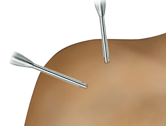 Fig. 3 - L’artroscopia è una tecnica chirurgica mini-invasiva che consente di operare a cielo chiuso senza “aprire” le articolazioni. Questo significa minore invasività, minori percentuali di complicanze, recupero post-operatorio più veloce rispetto agli interventi tradizionali a cielo aperto