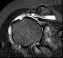 Fig. 5 – Immagine RMN di una lesione del sovraspinoso