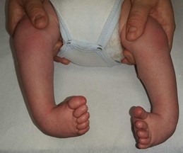 Fig.1: PTC bilaterale alla prima valutazione