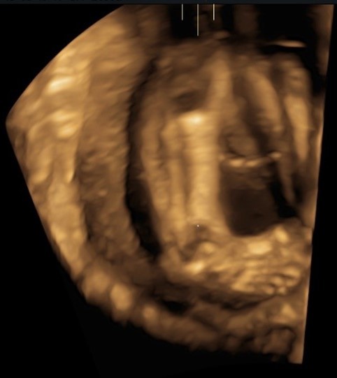 Fig.2: PTC destro in feto di 20 settimane – immagine ecografica