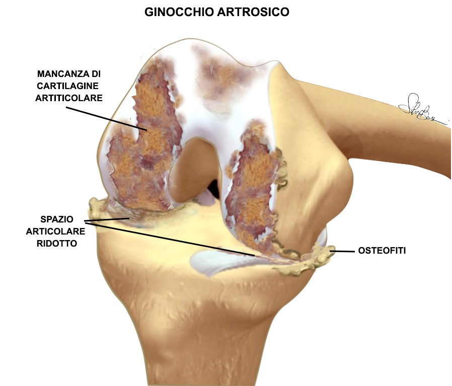Fig. 2 - Ginocchio artrosico