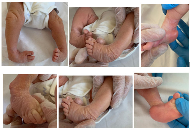 Fig.3: manipolazione del piede torto durante la valutazione della gravità e della rigidità della deformità