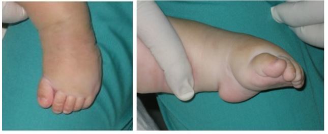 Fig.4: PTC atipico: tozzo e corto, in equinismo rigido e marcato, con profondo solco plantare, un primo metatarso corto e un alluce esteso a livello della metatarso-falangea e flesso a livello dell'interfalangea