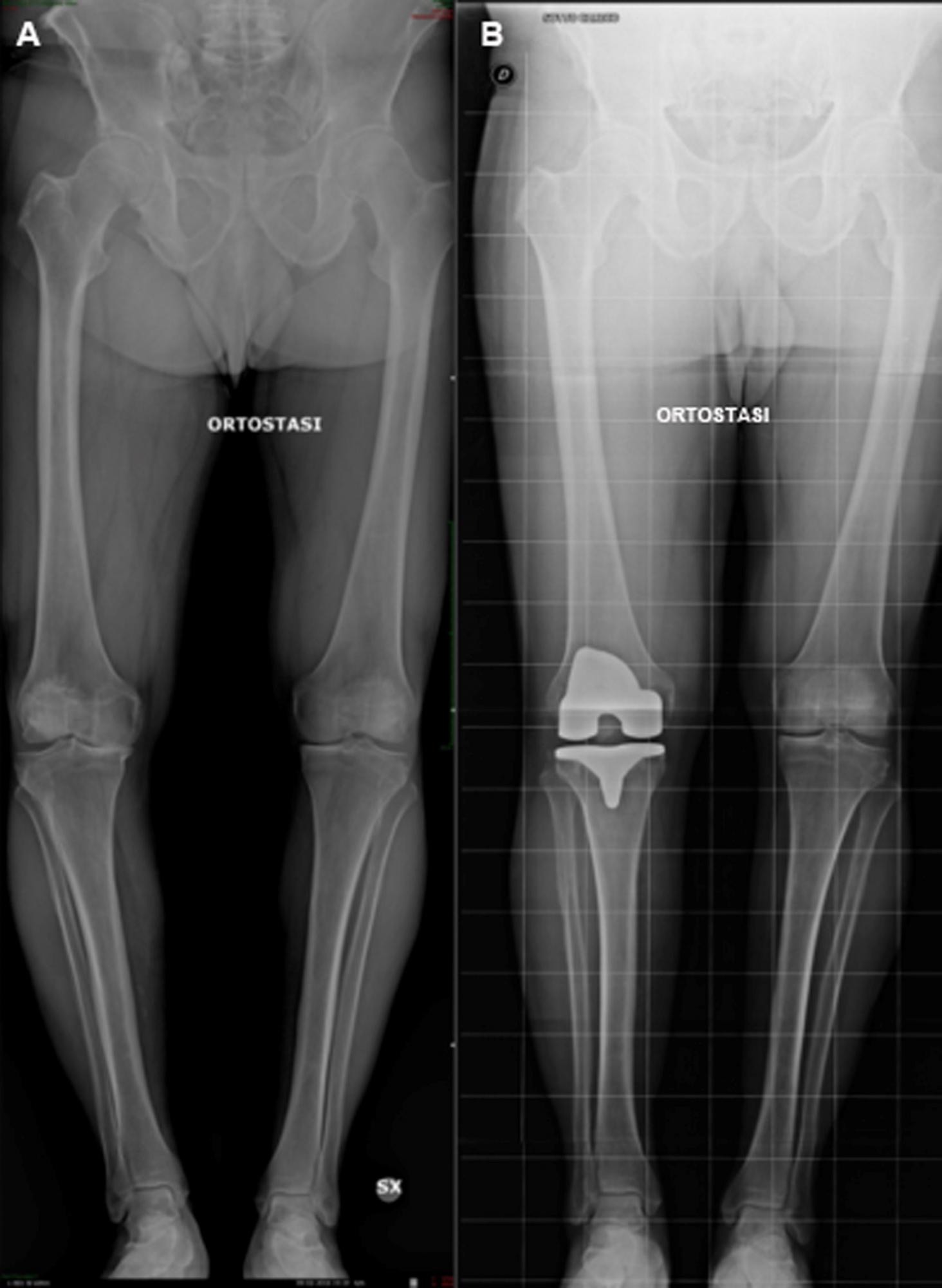 Fig. 5 - Controllo radiografico dopo protesi totale del ginocchio (B) eseguita per ginocchio varo artrosico (A). Dal controllo radiografico, eseguito in ortostasi (in piedi) si evince come l’asse del ginocchio protesizzato sia stato ripristinato