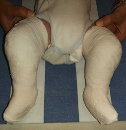 Fig.6: PTC bilaterale in trattamento con metodica Ponseti con ginocchiere gessate