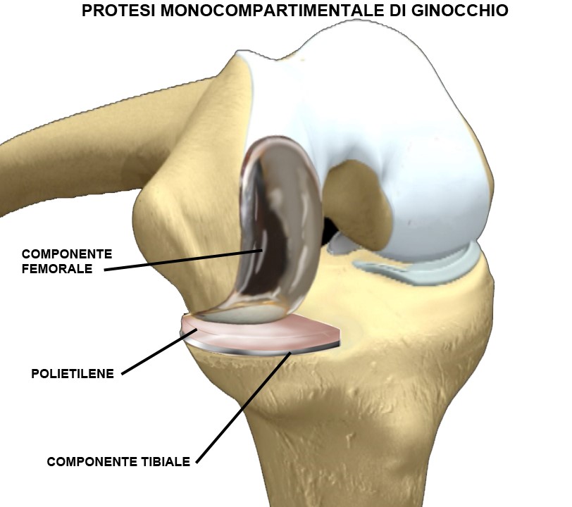 Fig. 6 - Protesi monocompartimentale mediale del ginocchio