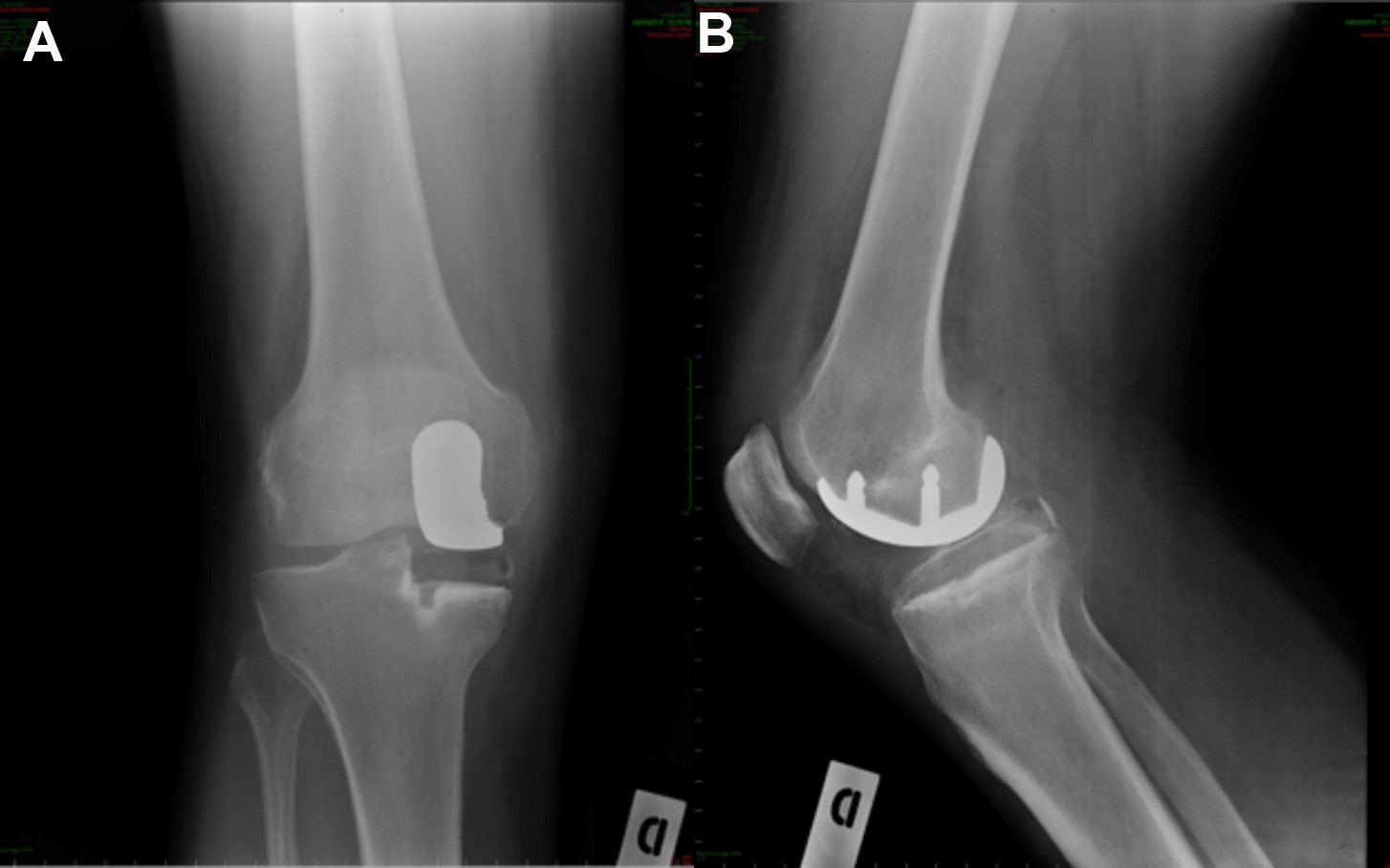 Fig. 7 - Controllo radiografico dopo protesi monocompartimentale mediale del ginocchio