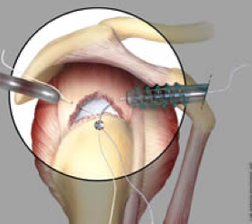 Fig. 6 – Schema di lesione del sovraspinoso: mediante artroscopia la lesione è individuata e in questo caso si utilizza una ancoretta per la sua fissazione all’osso