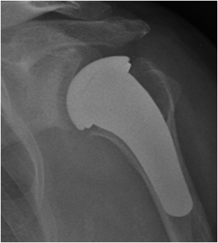 Fig. 3: Artrosi della spalla trattata con impianto di protesi a stelo corto rivestita in pirocarbonio