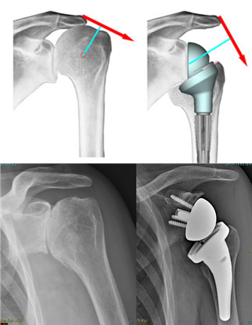 Fig. 4: Protesi inversa della spalla