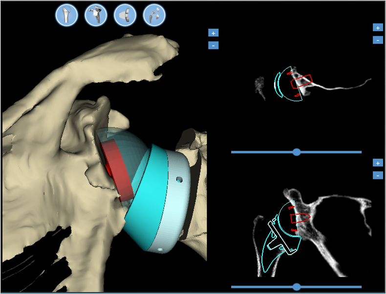 Fig. 5: Elaborazione pre-operatoria al computer, con posizionamento virtuale dell'impianto protesico sull'anatomia del paziente