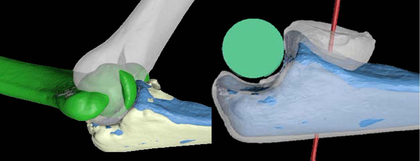 Fig. 6: Elaborazione pre-operatoria al computer in chirurgia ricostruttiva del gomito con utilizzo di sistemi stampati in 3D
