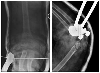 Fig. 5a-b: trattamento definitivo di frattura sovracondiloidea dell'omero distale con apparecchio gessato toraco-brachiale inglobante filo di trazione transcheletrico olecranico