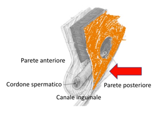 4. Inguinal disruption con cedimento della parete posteriore del canale inguinale e compressione del suo contenuto