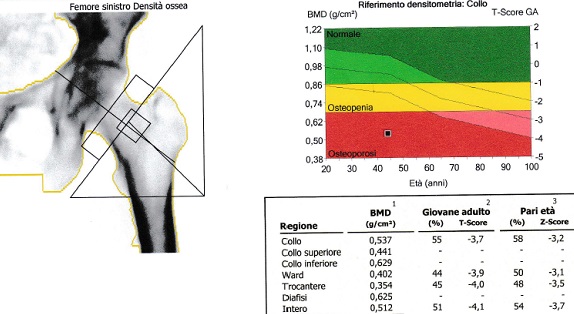 Indagine densitometrica tramite la Mineralometria Ossea Computerizzata (MOC): diagnosi di osteoporosi femorale.