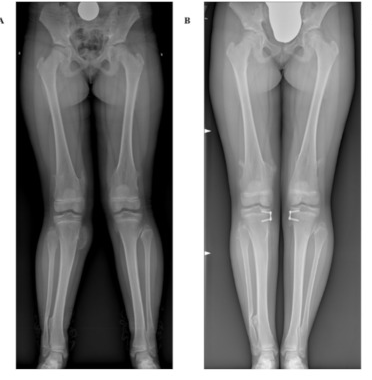FIG. 4 (a-b): esempio di correzione ginocchia valghe in Paziente affetto da esostosi multiple ereditarie.