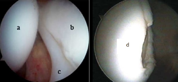 Figura 9: a-testa femorale, b- superficie acetabolare, c- labrum, d- lesione osteocondrale